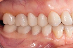 Figure 9: Lateral view of bonded functional prototypes Figure 9: Lateral view of bonded functional prototypes