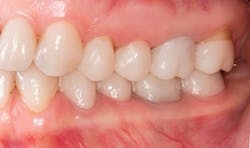 Figure 10: Lateral view of bonded functional prototypes Figure 10: Lateral view of bonded functional prototypes