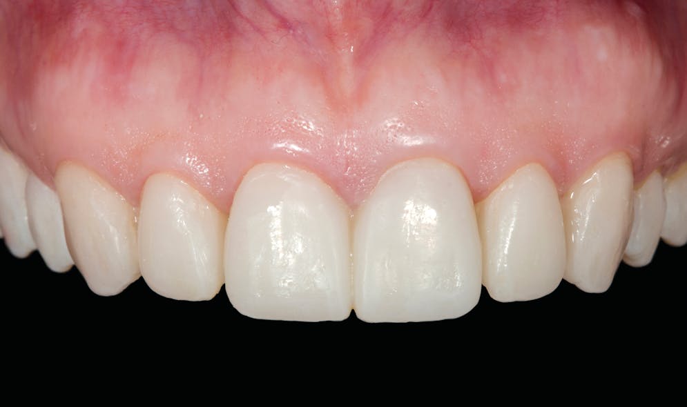 Figure 12: Frontal view of bonded prototypes