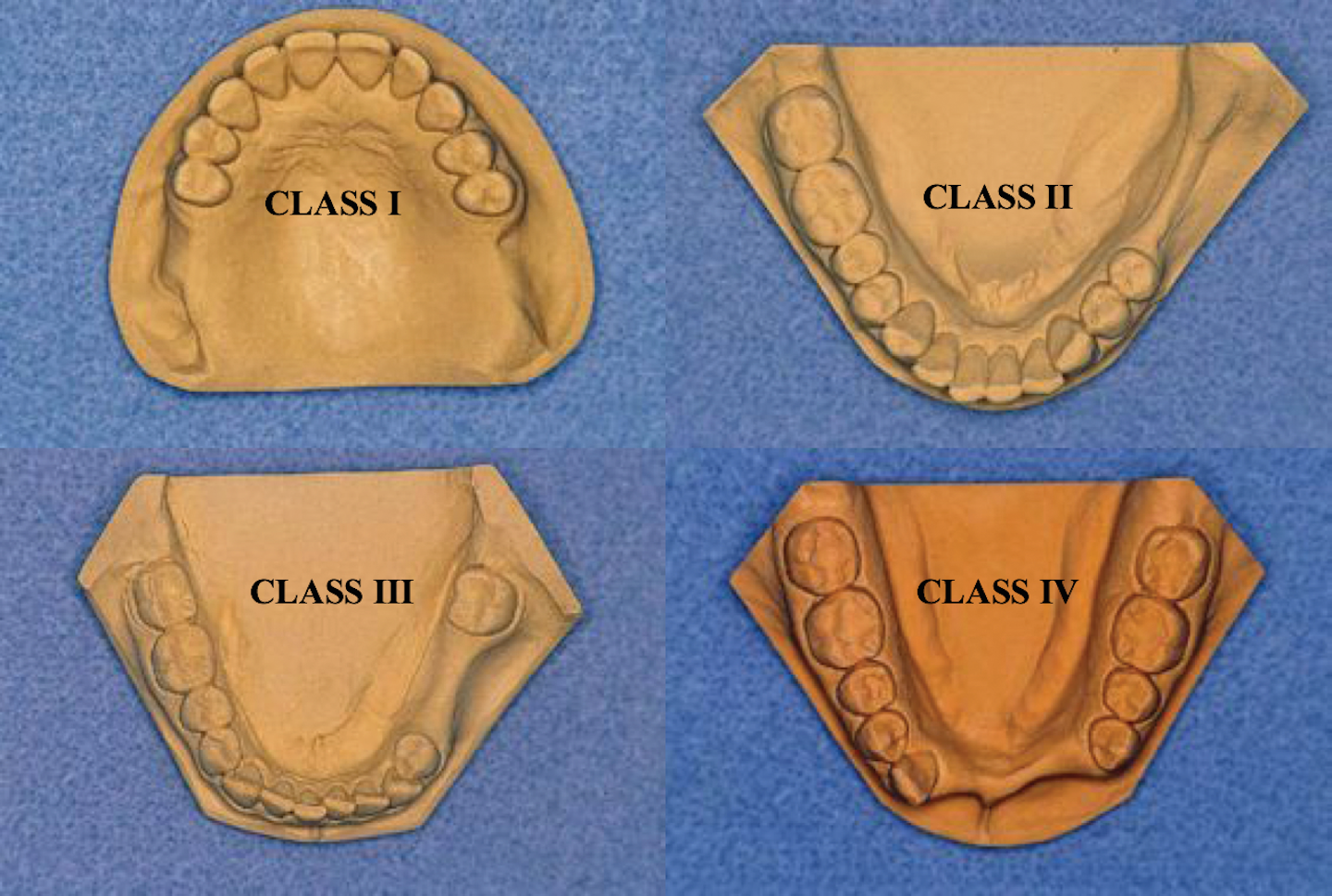 When are dental implants the best choice? Dental Economics