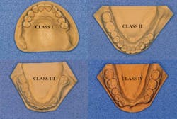 Figure 1: The Kennedy classification of partially edentulous clinical situations is relatively simple, but it is not used in practice as desired. The classification is excellent for laboratory technicians and other dentists to easily describe clinical characteristics in treatment plans.