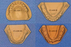 Figure 1: The Kennedy classification of partially edentulous clinical situations is relatively simple, but it is not used in practice as desired. The classification is excellent for laboratory technicians and other dentists to easily describe clinical characteristics in treatment plans. Figure 1: The Kennedy classification of partially edentulous clinical situations is relatively simple, but it is not used in practice as desired. The classification is excellent for laboratory technicians and other dentists to easily describe clinical characteristics in treatment plans.