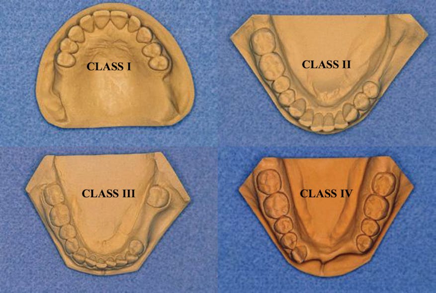 Figure 1: The Kennedy classification of partially edentulous clinical situations is relatively simple, but it is not used in practice as desired. The classification is excellent for laboratory technicians and other dentists to easily describe clinical characteristics in treatment plans.