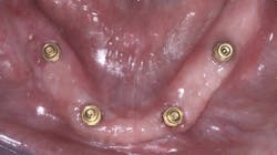 Figure 2: Four or more implants, retentive abutments, and a removable complete denture provide excellent function, esthetics, and repairability, plus a lower cost than fixed options. Figure 2: Four or more implants, retentive abutments, and a removable complete denture provide excellent function, esthetics, and repairability, plus a lower cost than fixed options.