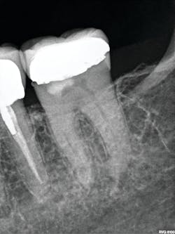 Figure 2: Preoperative CS 6200 projection radiograph of tooth no. 18 collected as a survey of the area is unremarkable for periapical findings. Clinical examination did not reveal any evidence of decay on the distal of tooth no. 19 or the mesial of no. 18. Figure 2: Preoperative CS 6200 projection radiograph of tooth no. 18 collected as a survey of the area is unremarkable for periapical findings. Clinical examination did not reveal any evidence of decay on the distal of tooth no. 19 or the mesial of no. 18.