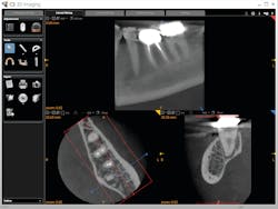 Figure 3: Preoperative CBCT has subtle findings periapical to the mesial root of no. 18. Figure 3: Preoperative CBCT has subtle findings periapical to the mesial root of no. 18.