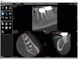 Figure 4: Preoperative CBCT has clear periapical findings distal to the root of no. 18. Noted as well is the root curvature that is not visible on projection radiography, aiding in treatment planning. Periapical findings on the previously treated (in another dental office) no. 19 (not shown) are within normal limits. Figure 4: Preoperative CBCT has clear periapical findings distal to the root of no. 18. Noted as well is the root curvature that is not visible on projection radiography, aiding in treatment planning. Periapical findings on the previously treated (in another dental office) no. 19 (not shown) are within normal limits.