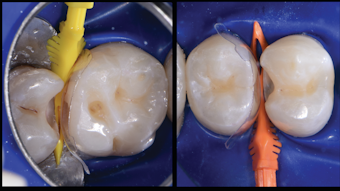 Moving Away From Metal Dental Economics