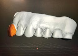 Figure 3: Modify the anterior setup as needed using Meshmixer software to elongate/shorten/position the centrals. Figure 3: Modify the anterior setup as needed using Meshmixer software to elongate/shorten/position the centrals.