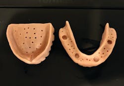 Figure 4: Using a #4 round bur, punch holes in the intaglios for the impression material to easily flow through, add a thin layer of adhesive, and cover the flanges. Figure 4: Using a #4 round bur, punch holes in the intaglios for the impression material to easily flow through, add a thin layer of adhesive, and cover the flanges.