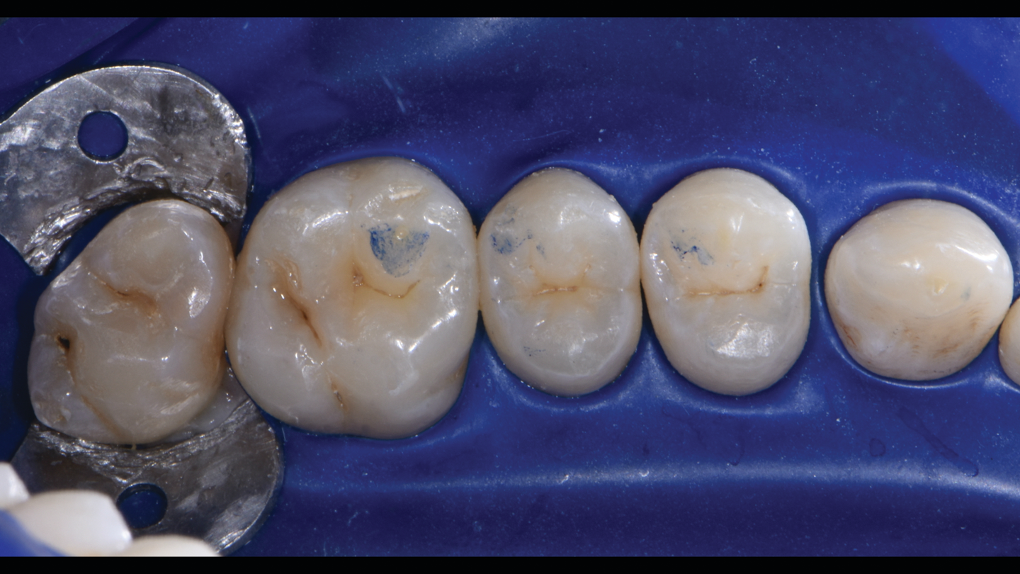 How to increase predictability and durability of posterior composite