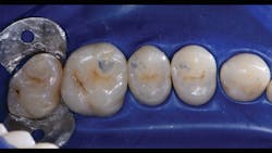 Figure 1: Posterior quadrant occlusion marked with articulating paper prior to rubber dam isolation. Marking the occlusion helps with decisions about cavity access and preparations. Figure 1: Posterior quadrant occlusion marked with articulating paper prior to rubber dam isolation. Marking the occlusion helps with decisions about cavity access and preparations.