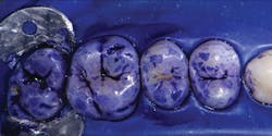 Figure 2: 2-Tone Disclosing Solution is applied to dried teeth to reveal biofilm. Figure 2: 2-Tone Disclosing Solution is applied to dried teeth to reveal biofilm.