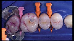 Figure 3: Quadrant is pre-wedged with a small Diamond Wedge (pink) and two medium Diamond Wedges (orange). 2-Tone Disclosing Solution is rinsed to reveal biofilm. Figure 3: Quadrant is pre-wedged with a small Diamond Wedge (pink) and two medium Diamond Wedges (orange). 2-Tone Disclosing Solution is rinsed to reveal biofilm.