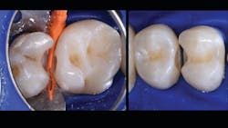 Figure 4: Quadrant is prepped, then biofilm and dentinal debris are removed with aluminum trihydroxide in Bioclear Blaster. No. 15 MOL prep, no. 14 DOL opportunistic prep, no. 13 MO opportunistic prep, and no. 12 DO prep. Figure 4: Quadrant is prepped, then biofilm and dentinal debris are removed with aluminum trihydroxide in Bioclear Blaster. No. 15 MOL prep, no. 14 DOL opportunistic prep, no. 13 MO opportunistic prep, and no. 12 DO prep.