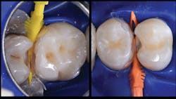 Figure 5: No. 14 distal is matrixed with Bioclear B302 matrix and stabilized with a large Diamond Wedge (yellow). No. 13 mesial is matrixed with Bioclear B302 matrix and stabilized with medium Diamond Wedge. (Orange).