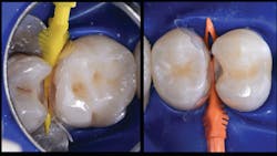 Figure 5: No. 14 distal is matrixed with Bioclear B302 matrix and stabilized with a large Diamond Wedge (yellow). No. 13 mesial is matrixed with Bioclear B302 matrix and stabilized with medium Diamond Wedge. (Orange). Figure 5: No. 14 distal is matrixed with Bioclear B302 matrix and stabilized with a large Diamond Wedge (yellow). No. 13 mesial is matrixed with Bioclear B302 matrix and stabilized with medium Diamond Wedge. (Orange).