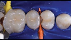 Figure 6: No. 14 DOL and no. 13 MO are filled before removal of the matrix and wedge and before shaping. Restored with 3M Scotchbond Universal Adhesive, 3M Filtek Bulk Fill Flowable Restorative Universal Shade, and 3M Filtek One Bulk Fill Restorative Shade B1. Figure 6: No. 14 DOL and no. 13 MO are filled before removal of the matrix and wedge and before shaping. Restored with 3M Scotchbond Universal Adhesive, 3M Filtek Bulk Fill Flowable Restorative Universal Shade, and 3M Filtek One Bulk Fill Restorative Shade B1.