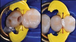 Figure 7: No. 15 MOL is matrixed with Biofit HD Molar 5.5 mm matrix, wedged with large Diamond Wedge (yellow), and separated with Bicuspid Twin Ring. No. 13 DO is matrixed with Biofit HD Bicuspid 5.5 mm matrix, wedged with medium Diamond Wedge (orange), and separated with Bicuspid Twin Ring. Figure 7: No. 15 MOL is matrixed with Biofit HD Molar 5.5 mm matrix, wedged with large Diamond Wedge (yellow), and separated with Bicuspid Twin Ring. No. 13 DO is matrixed with Biofit HD Bicuspid 5.5 mm matrix, wedged with medium Diamond Wedge (orange), and separated with Bicuspid Twin Ring.