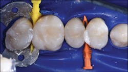 Figure 8: No. 15 MOL and no. 13 DO are filled and the Twin Rings removed. Both are restored with Scotchbond Universal Adhesive, Filtek Bulk Fill Flowable Universal Shade, and Filtek One Bulk Fill Shade B1. Figure 8: No. 15 MOL and no. 13 DO are filled and the Twin Rings removed. Both are restored with Scotchbond Universal Adhesive, Filtek Bulk Fill Flowable Universal Shade, and Filtek One Bulk Fill Shade B1.