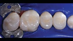 Figure 9: Occlusal view of the restored quadrant after disassembly. Shaping is quickly completed with 3M Sof-Lex XT Large Coarse Discs. Subgingival areas are finished with 3M Sof-Lex Finishing Strips. Polish is completed with Magic Mix prepolish (Bioclear) and diamond-impregnated rubber cup polisher. Figure 9: Occlusal view of the restored quadrant after disassembly. Shaping is quickly completed with 3M Sof-Lex XT Large Coarse Discs. Subgingival areas are finished with 3M Sof-Lex Finishing Strips. Polish is completed with Magic Mix prepolish (Bioclear) and diamond-impregnated rubber cup polisher.