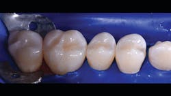 Figure 10: Buccal view of the quadrant after disassembly and polish. Figure 10: Buccal view of the quadrant after disassembly and polish.