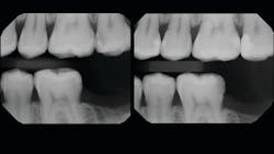 Figure 11: Pre- and postoperative radiographs of treated quadrant&mdash;teeth nos. 12&ndash;15. Note the very conservative nature of the preparations and the void-free monolithic fill with smooth subgingival contours, physiologic broad contacts, and rounded occlusal embrasures.