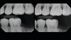 Figure 11: Pre- and postoperative radiographs of treated quadrant—teeth nos. 12–15. Note the very conservative nature of the preparations and the void-free monolithic fill with smooth subgingival contours, physiologic broad contacts, and rounded occlusal embrasures. Figure 11: Pre- and postoperative radiographs of treated quadrant—teeth nos. 12–15. Note the very conservative nature of the preparations and the void-free monolithic fill with smooth subgingival contours, physiologic broad contacts, and rounded occlusal embrasures.