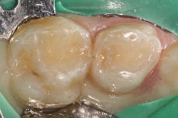 Figure 1: Preoperative isolated tooth A to be restored due to mesial caries