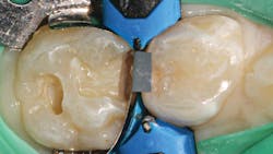 Figure 2: Conservative mesial-occlusal preparation on tooth A with Composi-Tight 3D XR matrix system