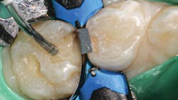 Figure 4: Placement of Admira Fusion x-base Figure 4: Placement of Admira Fusion x-base