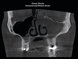 Figure 1: A chronic sinus infection was noted in a scan taken on a patient who was referred for fabrication of a mandibular advancement device to treat sleep apnea. Figure 1: A chronic sinus infection was noted in a scan taken on a patient who was referred for fabrication of a mandibular advancement device to treat sleep apnea.