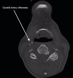 A carotid artery plaque (atheroma) can be seen encircling part of the lumen of the artery. This was an incidental finding in a scan taken on an airway/TMD patient. The existence of this plaque places the patient at a higher risk for stroke.