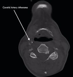 A carotid artery plaque (atheroma) can be seen encircling part of the lumen of the artery. This was an incidental finding in a scan taken on an airway/TMD patient. The existence of this plaque places the patient at a higher risk for stroke. A carotid artery plaque (atheroma) can be seen encircling part of the lumen of the artery. This was an incidental finding in a scan taken on an airway/TMD patient. The existence of this plaque places the patient at a higher risk for stroke.
