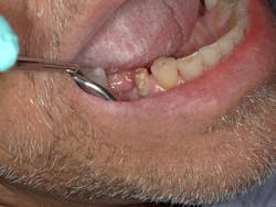 Figure 1: Prepared tooth no. 29 Figure 1: Prepared tooth no. 29