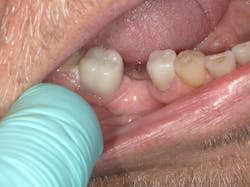 Figure 4: Try-in of crown for marginal fit, contact, occlusion, and shade Figure 4: Try-in of crown for marginal fit, contact, occlusion, and shade