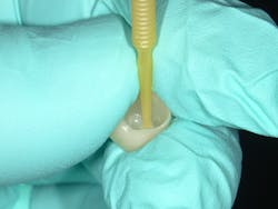 Figure 6: Cleansing and application of MDP zirconia primer to crown (Z-Prime, Bisco) Figure 6: Cleansing and application of MDP zirconia primer to crown (Z-Prime, Bisco)