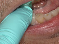 Figure 8: Crown fimly seated and held to place for light tacking Figure 8: Crown fimly seated and held to place for light tacking