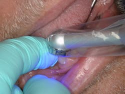 Figure 9: Three-to-five second light tack to accelerate gel phase for easy flash removal Figure 9: Three-to-five second light tack to accelerate gel phase for easy flash removal