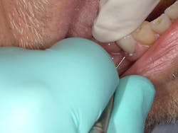 Figure 10: Cement easily removed with explorer in gel phase Figure 10: Cement easily removed with explorer in gel phase