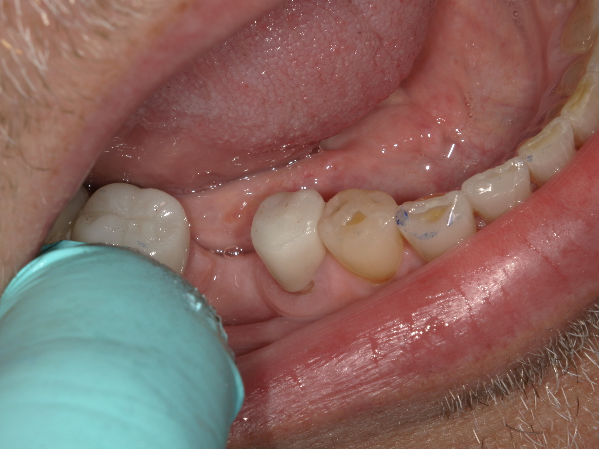 Figure 11: Final restoration following cleanup