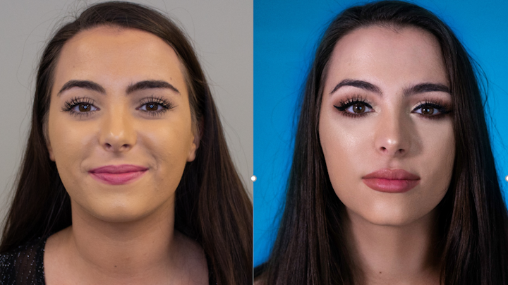 2009DECmal P01.5f5fbd4396f63, dermalfillerbeforeandafter The esthetic Zoom boom | Dental Economics, dermalfillerbeforeandafter