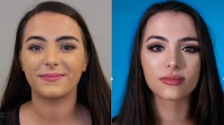 Millennial patients are the future of esthetic dentistry. They want facial esthetics earlier and done with noninvasive esthetic services. Millennial patients are the future of esthetic dentistry. They want facial esthetics earlier and done with noninvasive esthetic services.