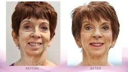 A mature patient before and after treatment with Botox, fillers, and lifting PDO threads. She is now ready for porcelain veneers and has better soft tissue support.