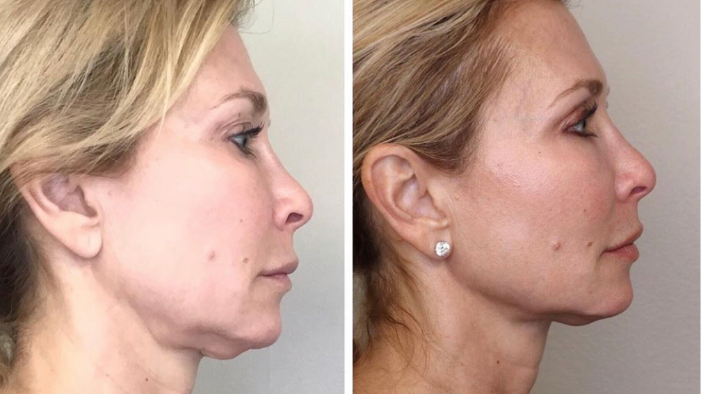 The four A's of digital marketing attracted this patient for elective esthetic services.