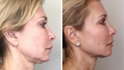 The four A's of digital marketing attracted this patient for elective esthetic services. The four A's of digital marketing attracted this patient for elective esthetic services.