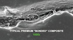 Figure 1: Typical premium, popular, so-called &ldquo;bonded&rdquo; composite adjacent to etched enamel, showing lack of marginal adaptation at 1,000x on a scanning electron microscope. Photo courtesy of TRAC Research, CR Foundation.