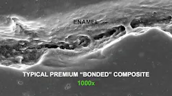 Figure 1: Typical premium, popular, so-called “bonded” composite adjacent to etched enamel, showing lack of marginal adaptation at 1,000x on a scanning electron microscope. Photo courtesy of TRAC Research, CR Foundation.