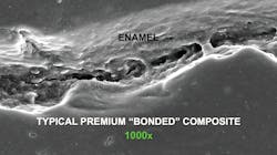 Figure 1: Typical premium, popular, so-called “bonded” composite adjacent to etched enamel, showing lack of marginal adaptation at 1,000x on a scanning electron microscope. Photo courtesy of TRAC Research, CR Foundation. Figure 1: Typical premium, popular, so-called “bonded” composite adjacent to etched enamel, showing lack of marginal adaptation at 1,000x on a scanning electron microscope. Photo courtesy of TRAC Research, CR Foundation.