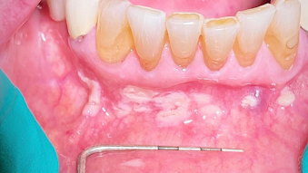 Zirconia Vs Lithium Disilicate Dental Economics
